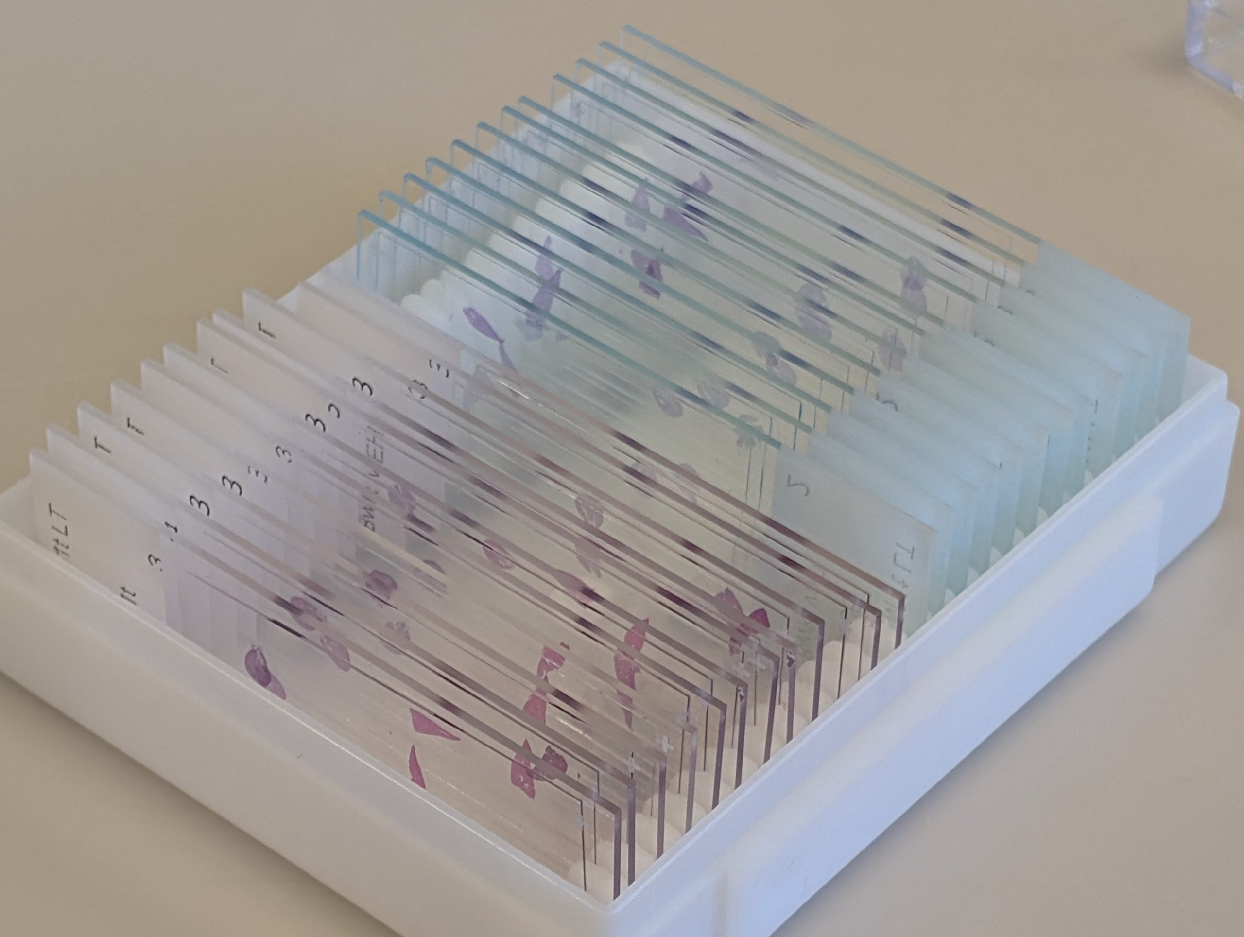 Are Flozins a treatment breakthrough for Alport syndrome?